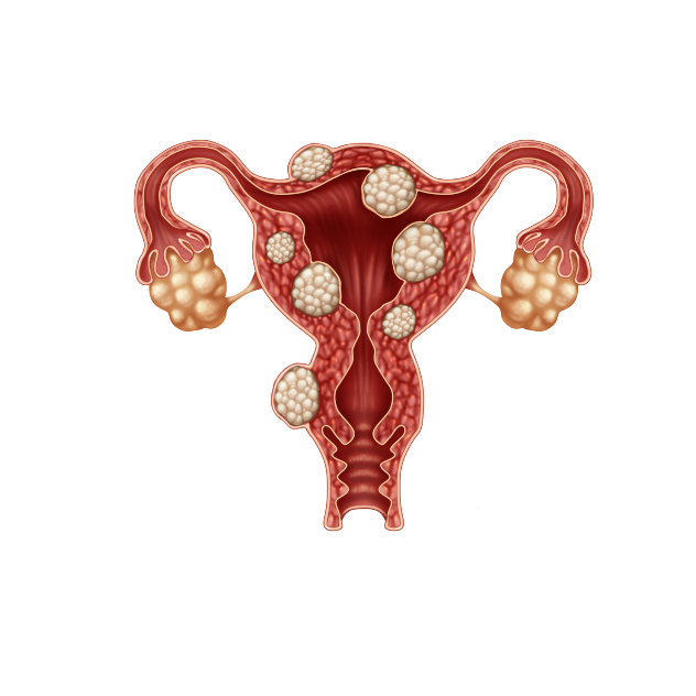 Fibroid Image